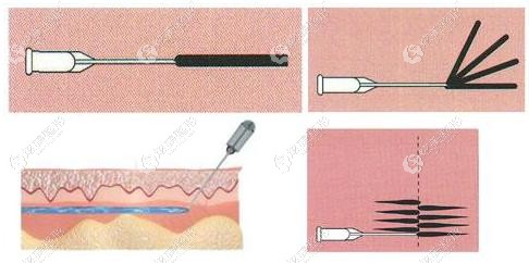 黄高敏医生注射乔雅登玻尿酸的技法 黄高敏医生注射乔雅登玻尿酸的技法