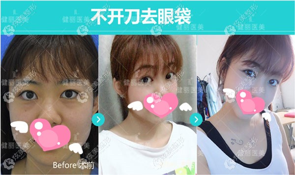 美诗沁针对轻度去眼袋做手术的效果 美诗沁针对轻度去眼袋做手术的效果