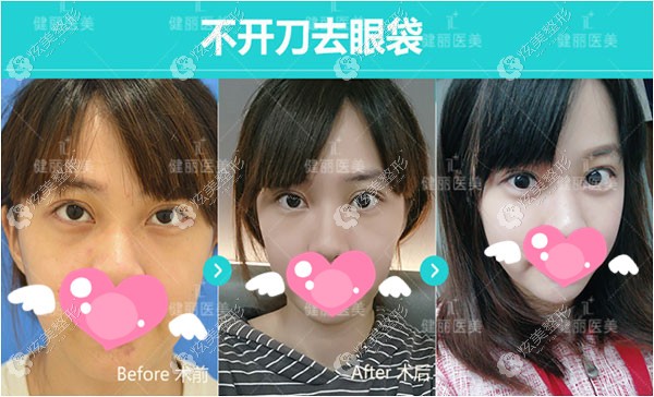 中度眼袋到美诗沁手术后的真实反馈 中度眼袋到美诗沁手术后的真实反馈