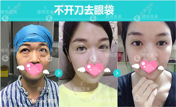 重度眼袋+泪沟术前术后的对比效果 重度眼袋+泪沟术前术后的对比效果