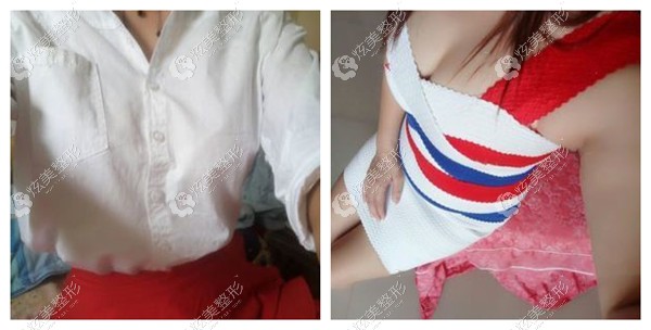 赵峰医生做沸腾沟丰胸前后对比 赵峰医生做沸腾沟丰胸前后对比