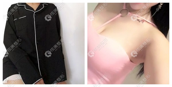 济南海峡整形赵峰医生做沸腾沟丰胸<span style= 济南海峡整形赵峰医生做沸腾沟丰胸<span style=