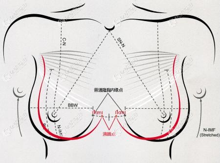 赵峰医生做沸腾沟丰胸优势 赵峰医生做沸腾沟丰胸优势