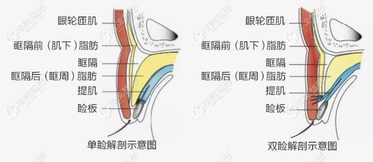 宋桂霞医生做双眼皮过程 宋桂霞医生做双眼皮过程