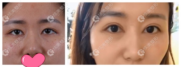 瑞丽整形医生宋桂霞修复双眼皮对比图 瑞丽整形医生宋桂霞修复双眼皮对比图