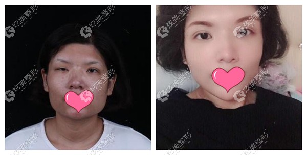 宋桂霞医生做眼综合修复对比图 宋桂霞医生做眼综合修复对比图