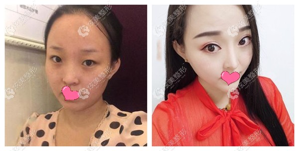 宋桂霞割双眼皮<span style= 宋桂霞割双眼皮<span style=