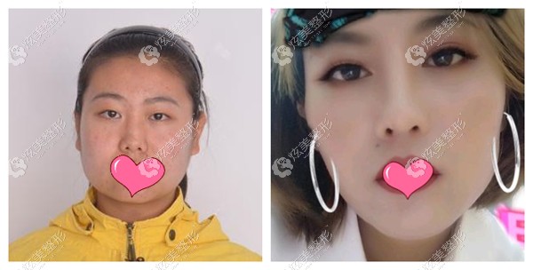 瑞丽整形宋桂霞做眼综合对比 瑞丽整形宋桂霞做眼综合对比