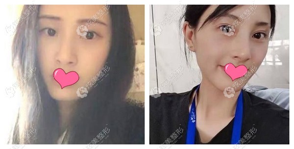 宋桂霞医生做眼综合<span style= 宋桂霞医生做眼综合<span style=