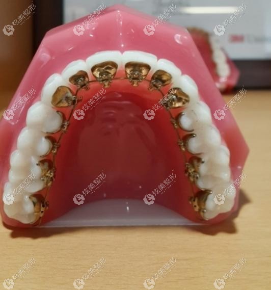 3M公司的Incognito舌侧矫治器 3M公司的Incognito舌侧矫治器