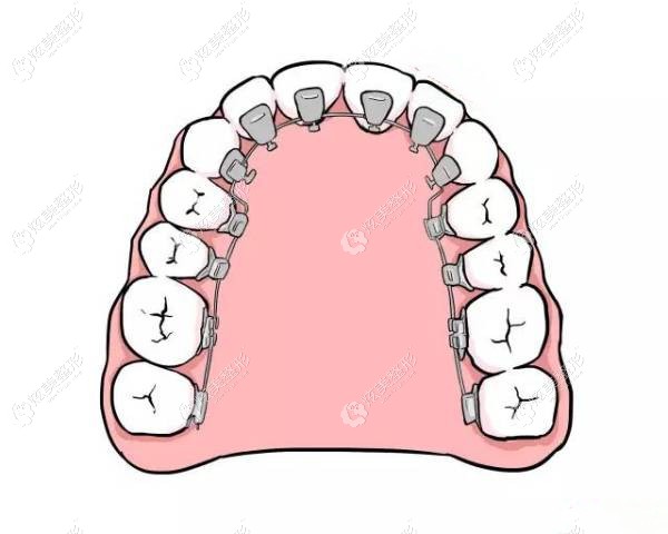 舌内侧牙套的优缺点 舌内侧牙套的优缺点