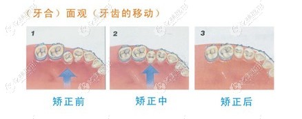 牙齿矫正前后对比 牙齿矫正前后对比