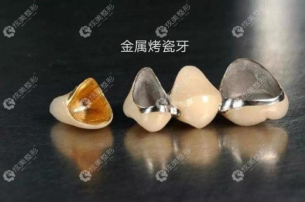 烤瓷牙牙龈发黑的原因 烤瓷牙牙龈发黑的原因