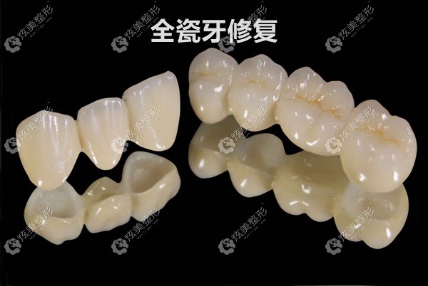 采用全瓷牙修复牙龈发黑的烤瓷牙 采用全瓷牙修复牙龈发黑的烤瓷牙