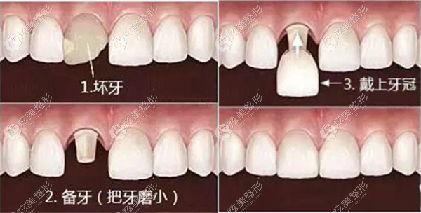烤瓷牙需要磨牙才能戴冠 烤瓷牙需要磨牙才能戴冠