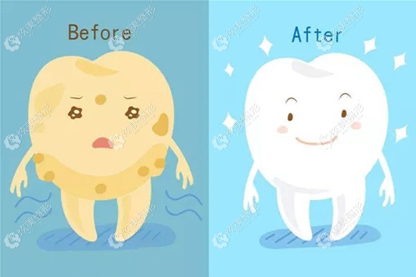 圣贝口腔做超声波洁牙的对比图 圣贝口腔做超声波洁牙的对比图