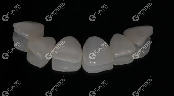 圣贝做全瓷贴面选用的材料 圣贝做全瓷贴面选用的材料