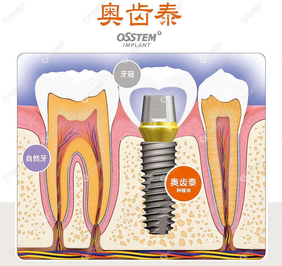 韩国奥齿泰种植体的特点 韩国奥齿泰种植体的特点