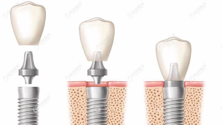 瑞士iti种植体的过程 瑞士iti种植体的过程