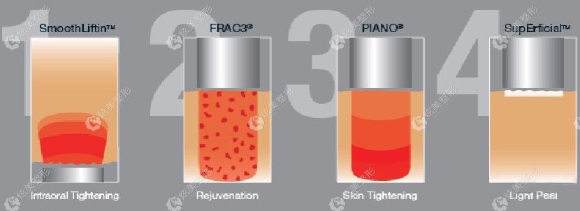 欧洲之星通过4个模式改善面部各种问题 欧洲之星通过4个模式改善面部各种问题