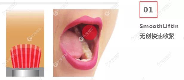 fotona 4d口内做激光的原理 fotona 4d口内做激光的原理