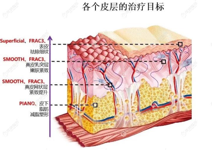 fotona 4d各个模式针对不同皮层的改善 fotona 4d各个模式针对不同皮层的改善
