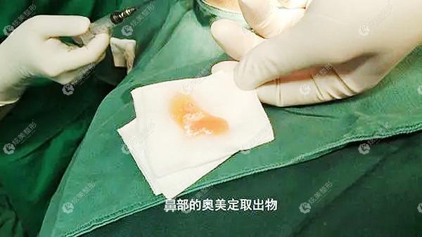 做鼻部奥美定注射取出手术 做鼻部奥美定注射取出手术