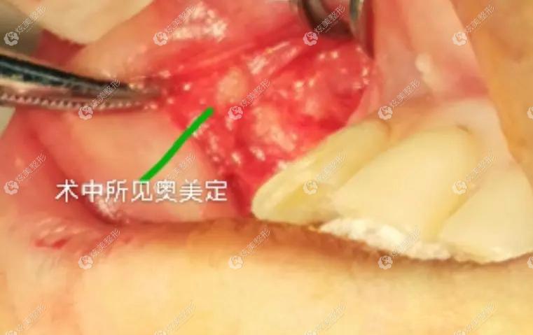 清奥手术中看到在鼻翼缘下方的奥美定 清奥手术中看到在鼻翼缘下方的奥美定