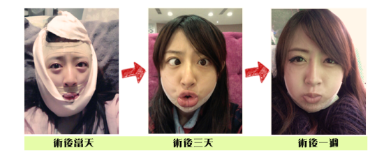 上海磨骨哪家整形医院比较好?