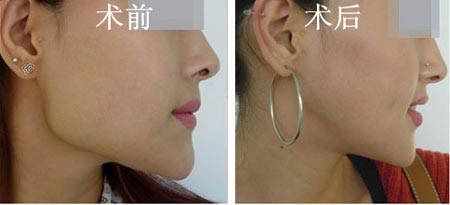 上海磨骨哪家整形医院比较好?