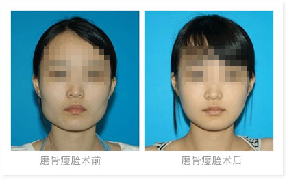 上海磨骨哪家整形医院比较好?