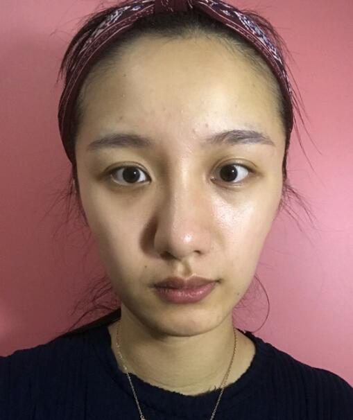 深圳非凡整形医院脂肪填充案例,附价格表~