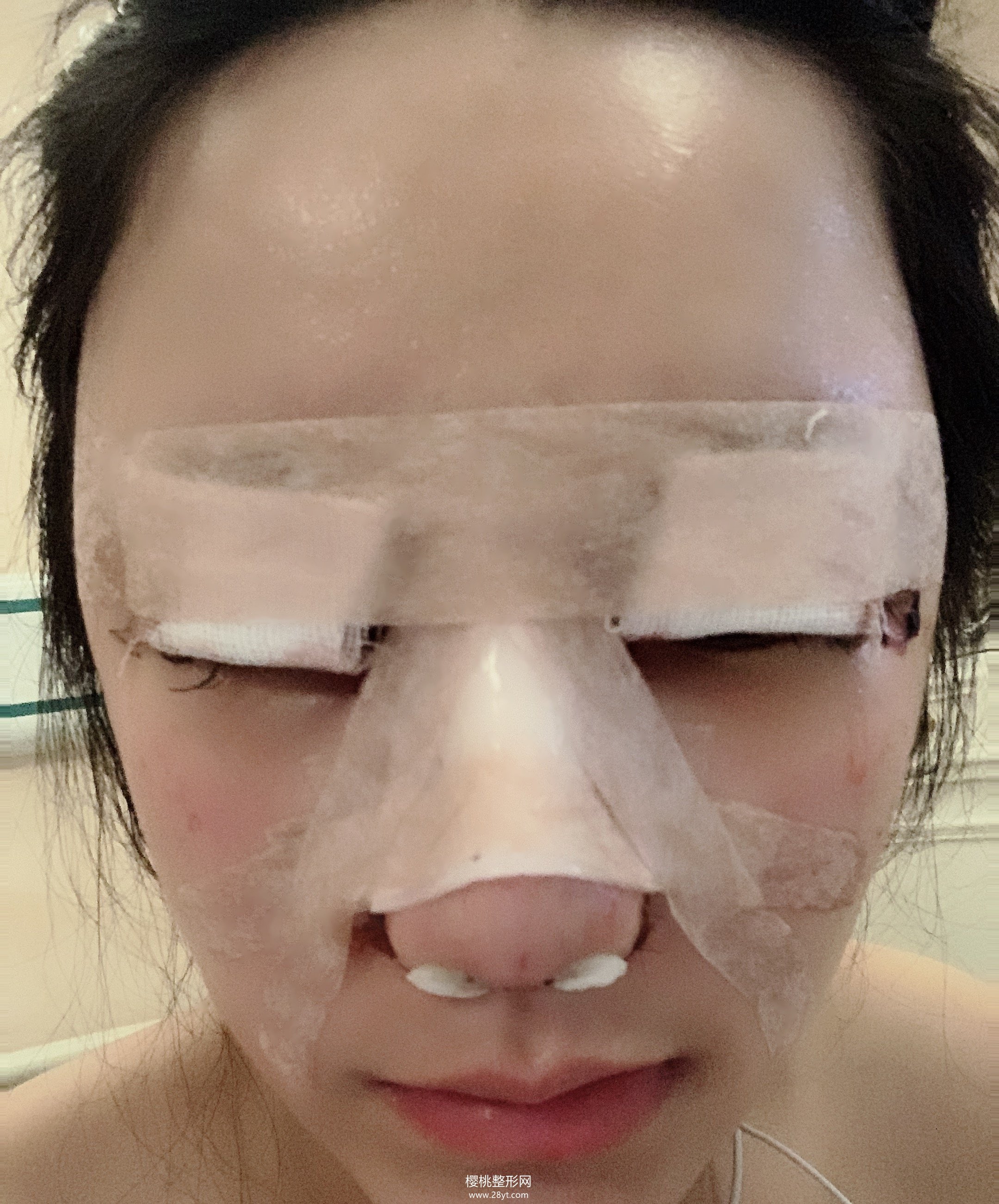 福州格莱美任正义做双眼皮如何?附真人案例+2021最新价格表一览