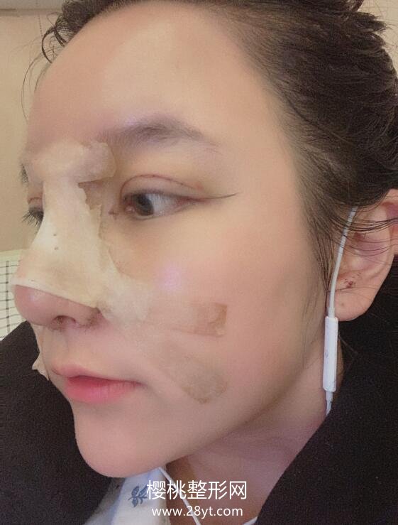 福州格莱美任正义做双眼皮如何?附真人案例+2021最新价格表一览