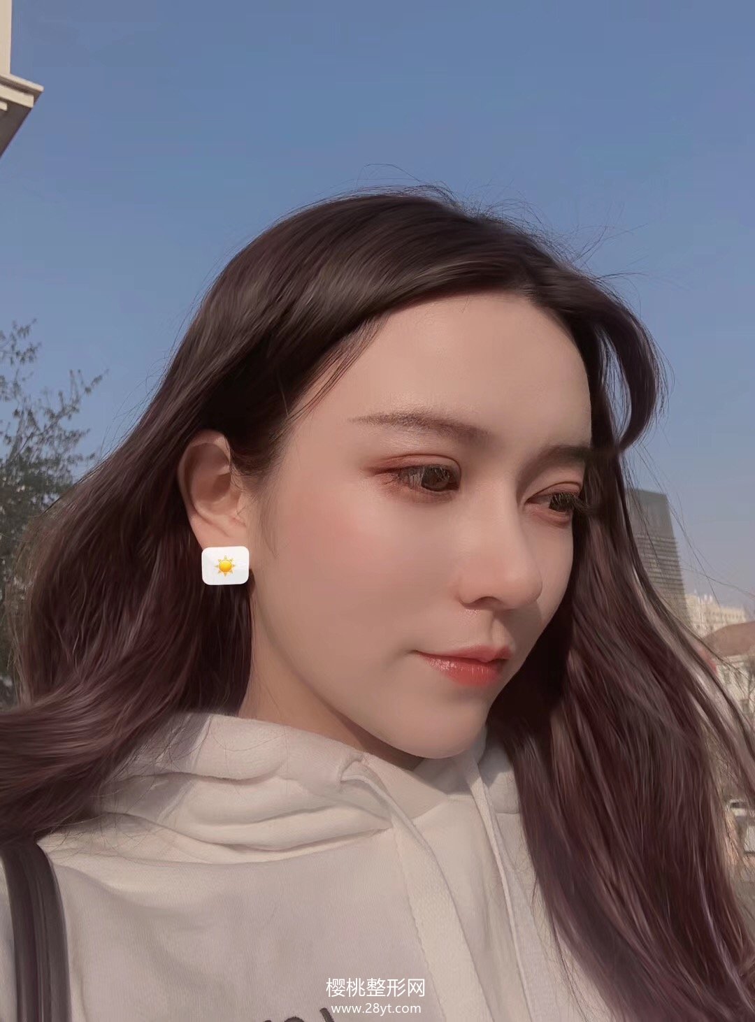 福州格莱美任正义做双眼皮如何?附真人案例+2021最新价格表一览