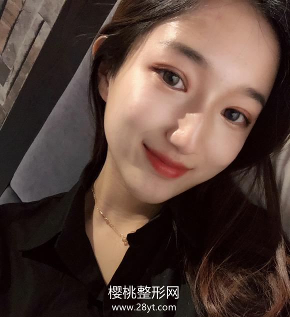 石家庄美莱李锦卓割双眼皮技术怎样?案例+价格表一览