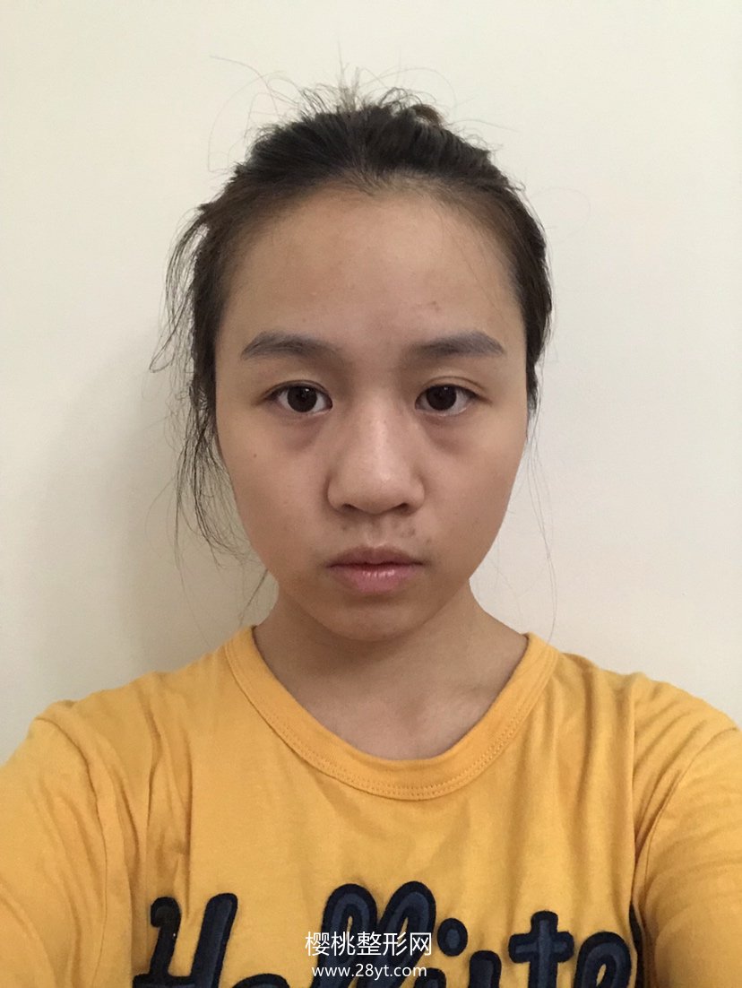 济南海峡徐永隆鼻怎么样?案例+价格表一览