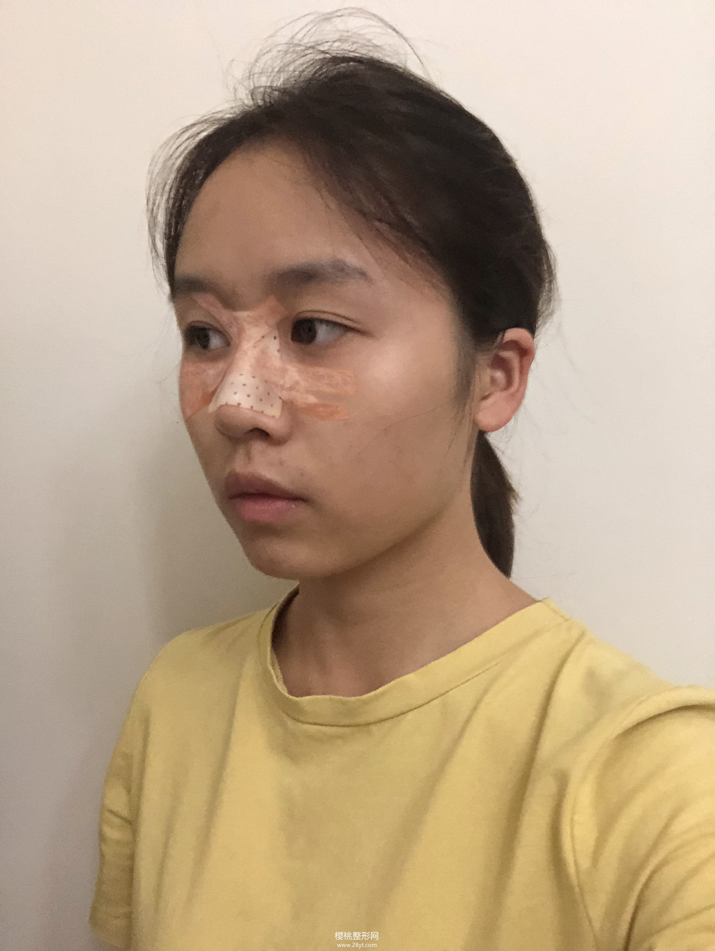 济南海峡徐永隆鼻怎么样?案例+价格表一览