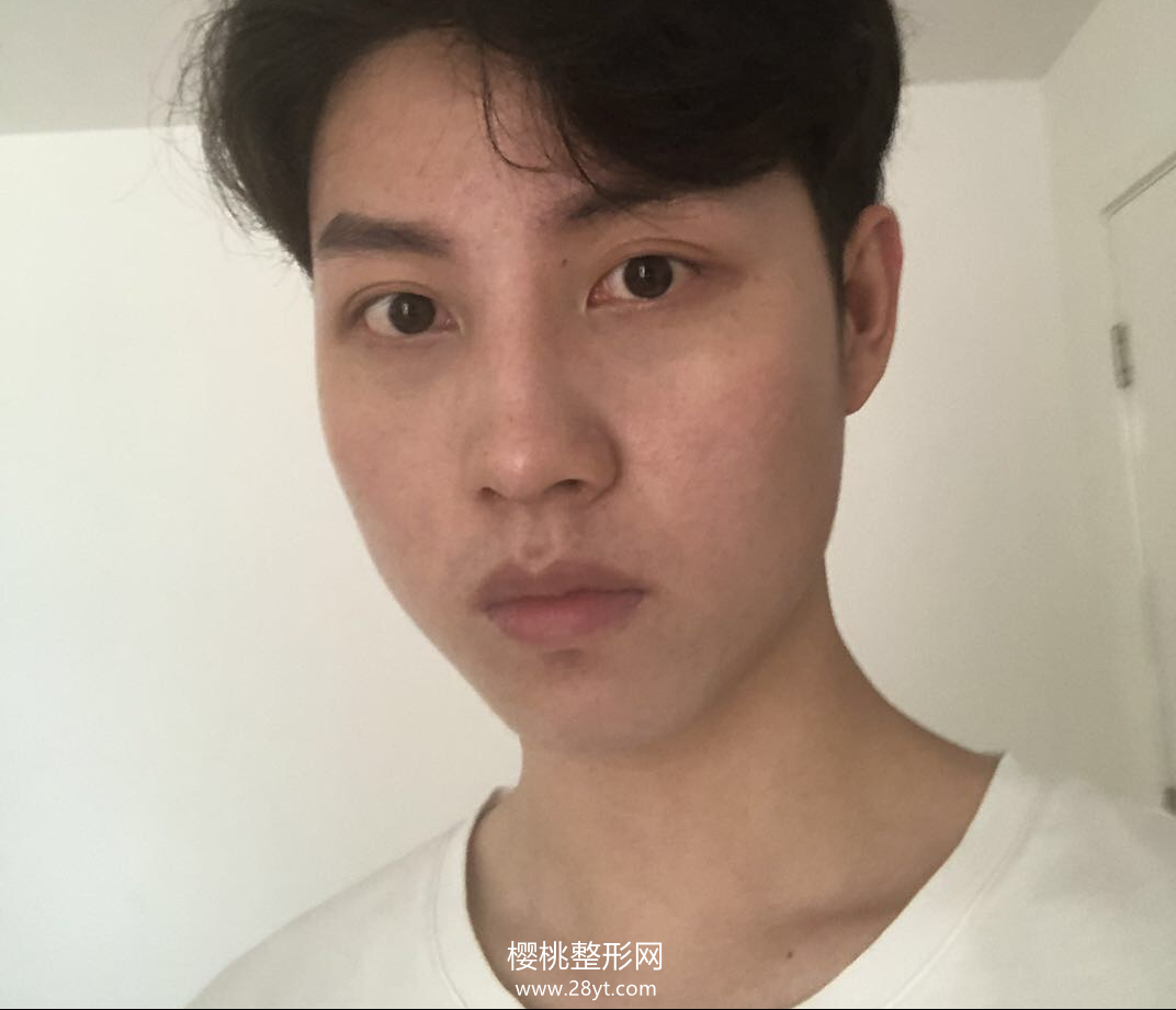 武汉欧尚美王大山隆鼻技术如何?附真人案例+最新价格表一览