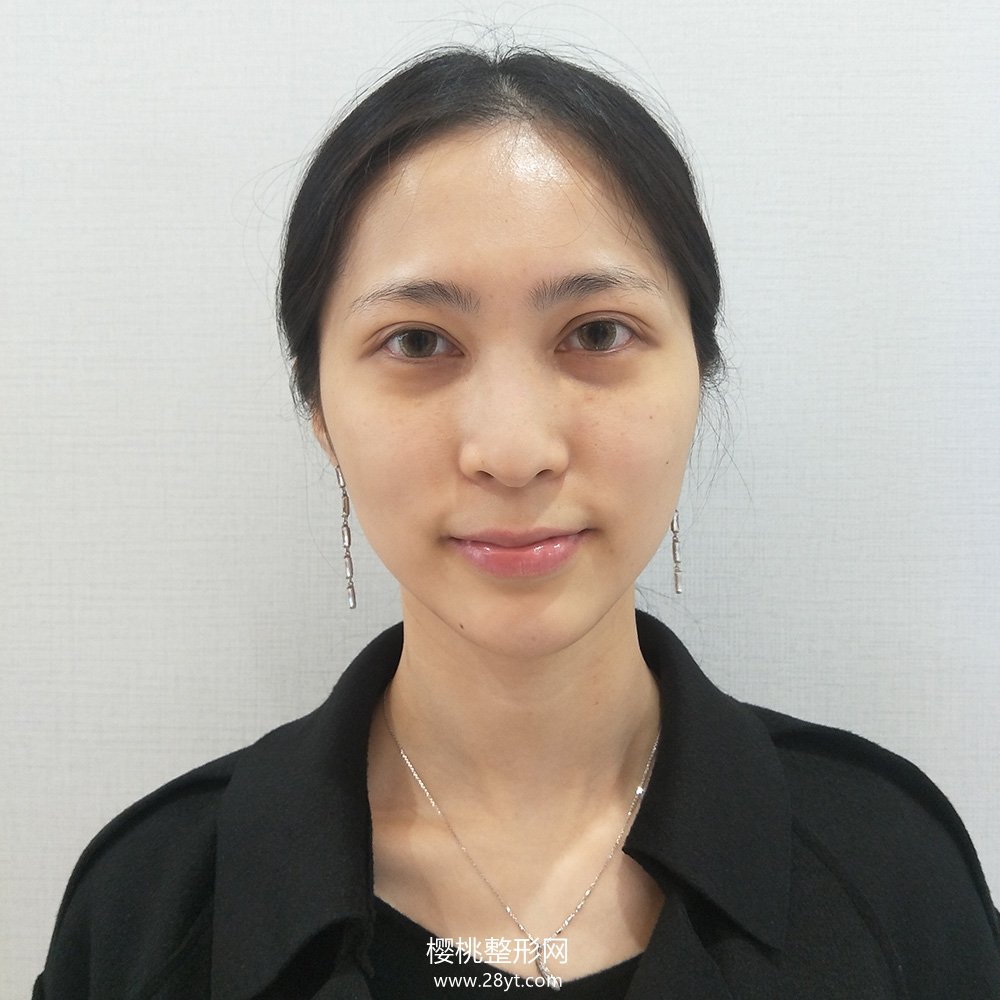 武汉匠歆天巧邓裴隆鼻技术如何?真人案例+最新价格表一览