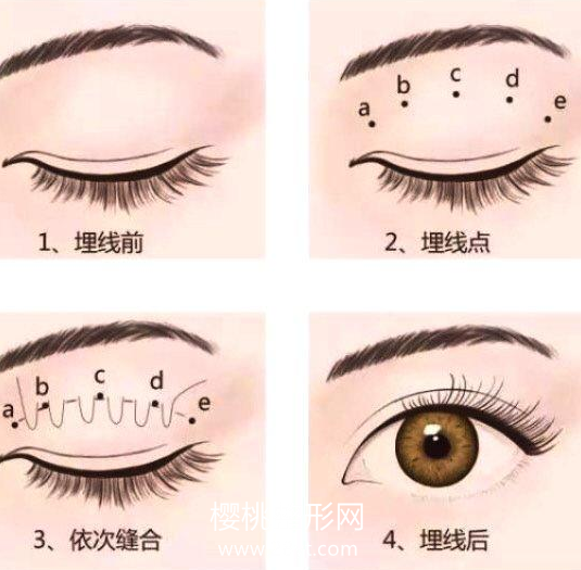 单眼皮怎么变成双眼皮?手术价格是多少?