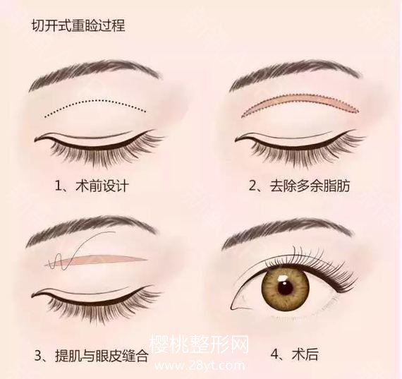 单眼皮怎么变成双眼皮?手术价格是多少?