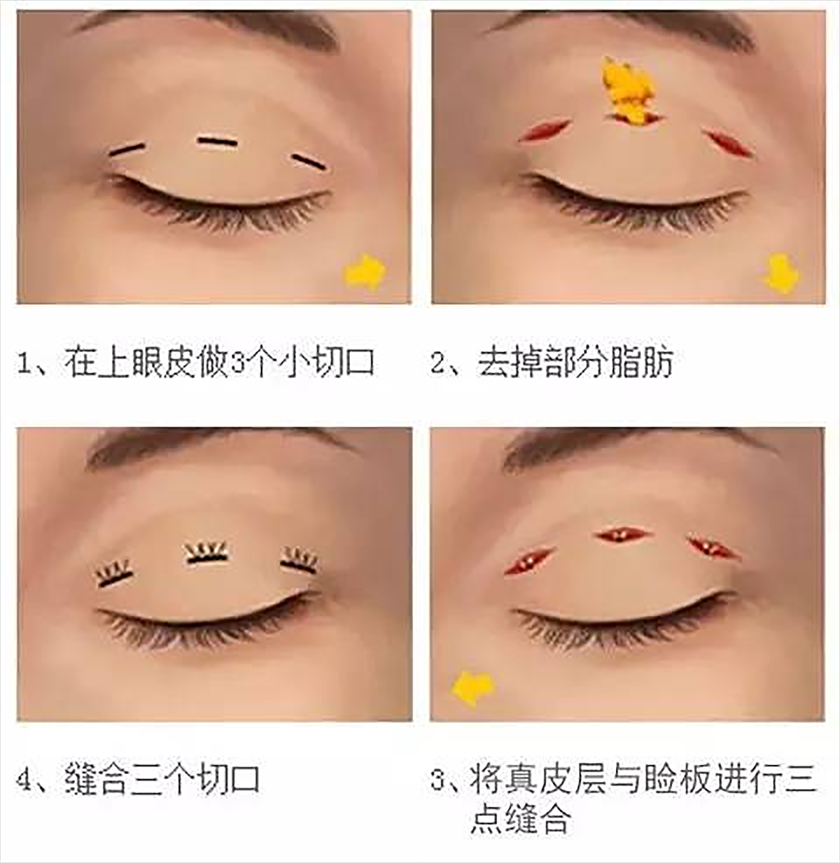 单眼皮怎么变成双眼皮?手术价格是多少?