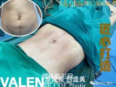 瘦肩针有什么功效？瘦肩