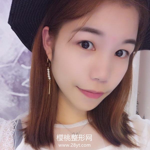 合肥华美赵辑双眼皮做的怎么样?有真人案例参考吗?贵不贵