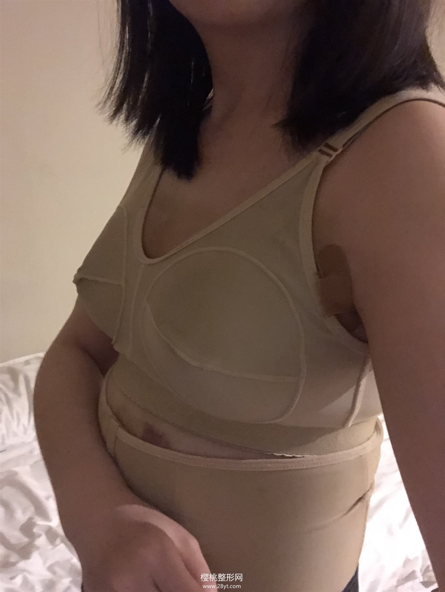 福州海峡林沸腾隆胸技术如何?附真人案例+最新价格表一览