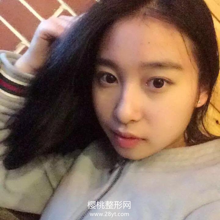 福州海峡薛克墘隆鼻技术怎么样?附真人案例+最新价格表一览