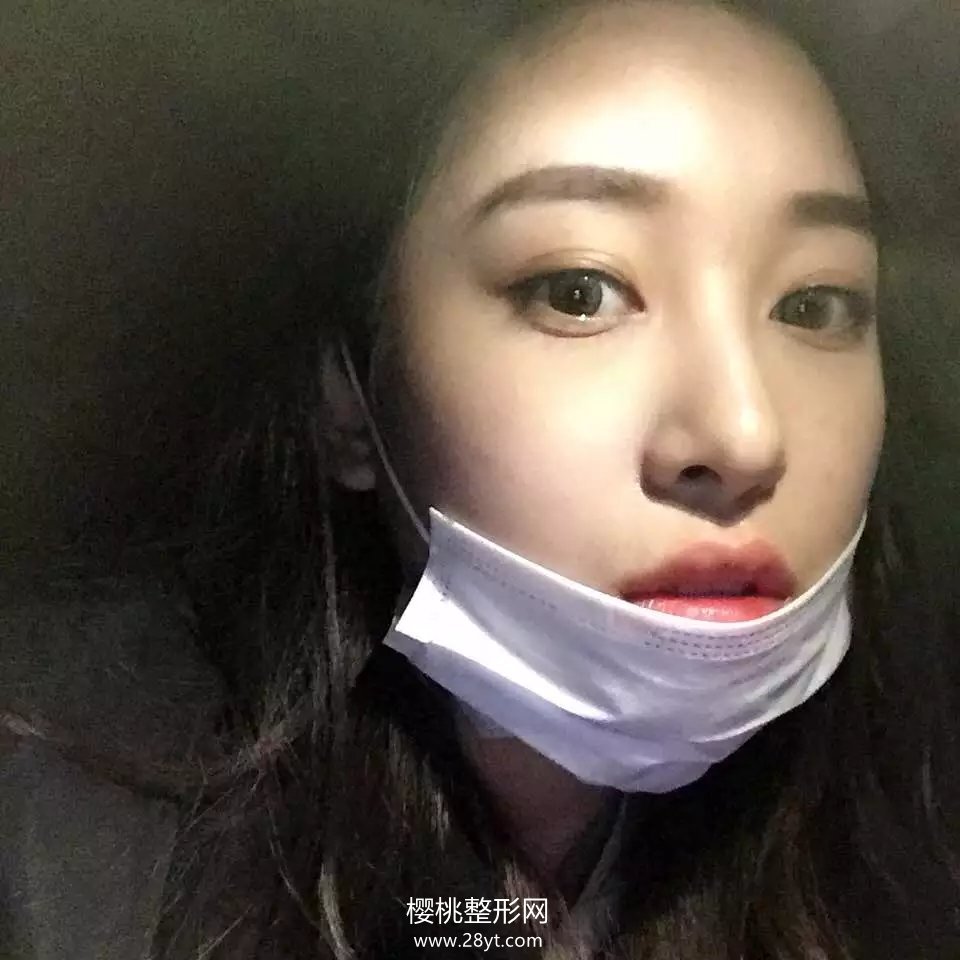 福州海峡薛克墘隆鼻技术怎么样?附真人案例+最新价格表一览