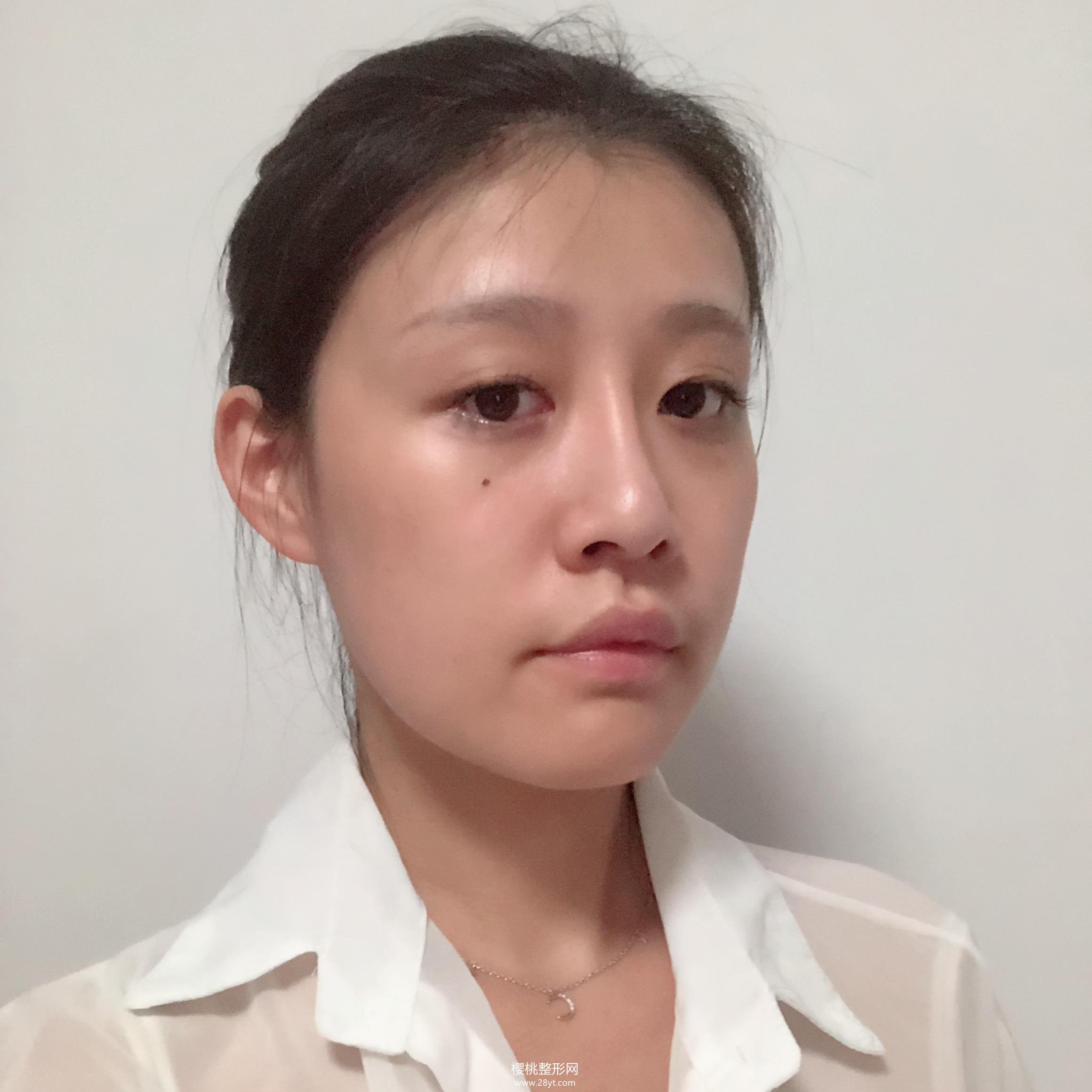 福州海峡李丽强做双眼皮技术怎么样?附真人案例+最新价格表一览