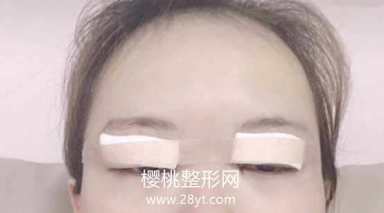 福州海峡李丽强做双眼皮技术怎么样?附真人案例+最新价格表一览